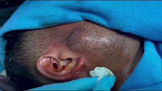 FACE ABSCESS  An immediate improvement after pus aspiration  Needle aspiration [upl. by Firooc]