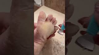 Foot peel mask series  TikTok Compilation 2  Do foot peeling masks work with EPPK Keratoderma [upl. by Whatley587]