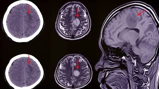 Subdural Hematoma SDH  Diagnosis management Burr hole surgery or craniotomy [upl. by Hennessey]