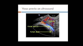 Placental abnormalities  Placenta Previa Vasa Previa Placenta Accreta  Placental Abruption [upl. by Jared]