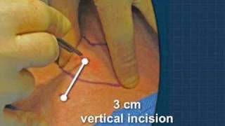 Cricothyrotomy [upl. by Sturdivant]