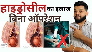 हाइड्रोसील का इलाज बिना सर्जरी 🔥 Hydrocele Treatment Without Surgery  Gyanear [upl. by Giffie]