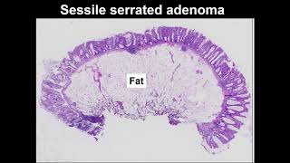 Serrated polyps Learn to tell the difference between hyperplastic polyp and sessile serrated lesion [upl. by Abbotson]