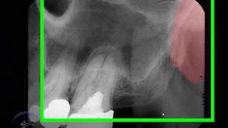 Proceso pterigoideo y apofisis hamular Pterygoid Plateshamular process [upl. by Seta]