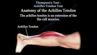 Thompsons Test Achilles Tendon Tear  Everything You Need To Know  Dr Nabil Ebraheim [upl. by Yelik]