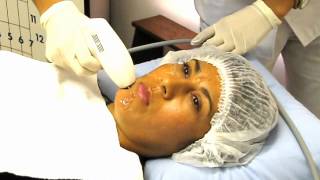 Radiofrecuencia facial  tensado facial o lifting sin cirugia [upl. by Enej]