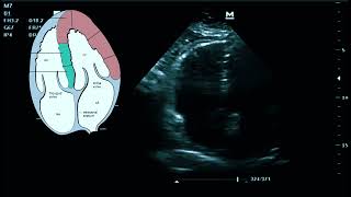 Signos ecocardiográficos de tromboembolia pulmonar short [upl. by Elockin]