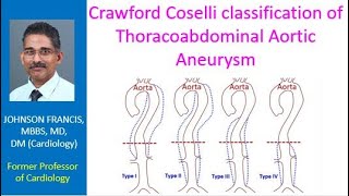 Crawford Coselli classification of Thoracoabdominal Aortic Aneurysm [upl. by Arlette652]