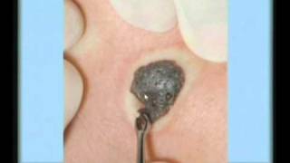 Seborrheic Keratosis Treatment [upl. by Pulsifer]