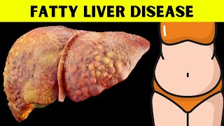 The Ultimate Guide to Understanding Fatty Liver Disease Everything You Should Know About Fatty Liver [upl. by Ettevol]