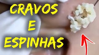 Como Remover Cravos do Rosto  Removendo CRAVOS e ESPINHAS GIGANTES 015 [upl. by Lacsap]