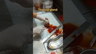 Cystic thyroid gland gross pathology [upl. by Justino483]