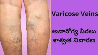 Varicose Veins  Symptoms amp Laser Treatment in Hyderabad in Telugu  అనారోగ్య సిరలు శాశ్వత నివారణ [upl. by Sherlocke]