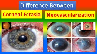 Difference Between Corneal Ectasia and Neovascularization [upl. by Derril]