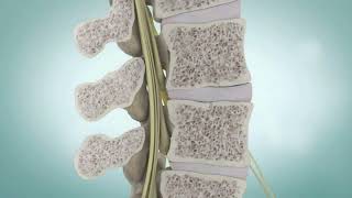 Spinal Stenosis and Spine Surgery  Medical Animation [upl. by Enyawd]