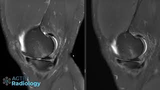 Knee MRI in 5 min YES [upl. by Sana]