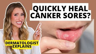 Quickly Heal Canker Sores How to Prevent amp Heal Them Faster  Dermatologist Explains [upl. by Nnyleimaj443]