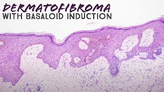 Dermatofibroma with basaloid follicular induction pathology mimic of basal cell carcinoma dermpath [upl. by Selry632]