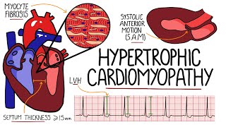 Hypertrophic Cardiomyopathy Made Easy  Includes Hypertrophic Obstructive Cardiomyopathy amp SAM [upl. by Adur932]