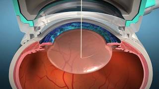 Watch live surgery using the laser cataract system  how does it work Eye News TV [upl. by Ainsworth]