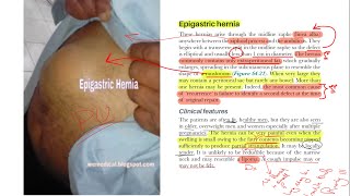 Hernia surgery part 6  Other types  Epigastric Spigelian Lumbar Trumatic Hernias [upl. by Perpetua64]