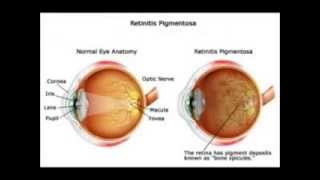 treatment for retinitis pigmentosa [upl. by Zebapda]