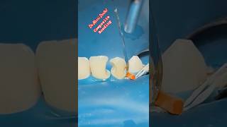 Composite BONDING teeth [upl. by Grant]