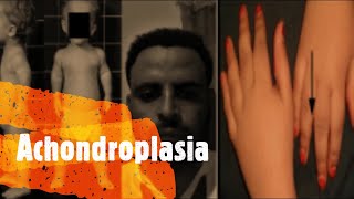 Achondroplasia Group [upl. by Alisander]