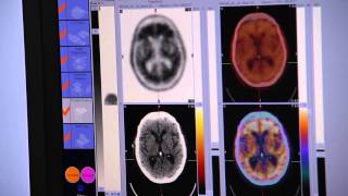 Uses of Florbetapir PET Scans Set to Take Shape [upl. by Kudva]