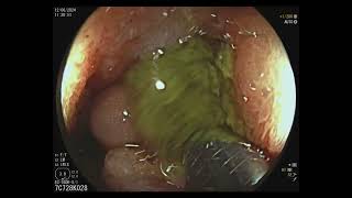 Subocclusion Treated by Colonic Stent Placement [upl. by Eirffej]