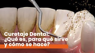 Curetaje Dental ¿Qué es y cómo se hace [upl. by Norma]