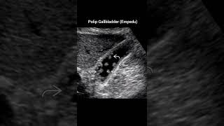 Polyp gallbladderpolip empedu usg radiology polyps gallbladder batu xray [upl. by Ggerk668]