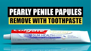 How to Remove PPP Pearly Penile Papules using Fluoride Toothpaste [upl. by Rihaz]