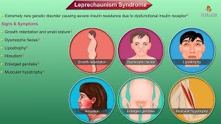 Leprechaunism  Donohue syndrome  Animation [upl. by Ranson]