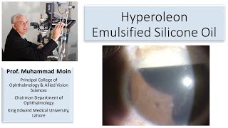 Emulsification of Silicone Oil in Eye [upl. by Kcirad]