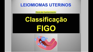 Classificação FIGO dos Leiomiomas Uterinos  Pílula de Conhecimento [upl. by Erv836]