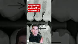 DIAGNÓSTICO RADIOGRÁFICO DE CARIES  Caries dental en radiografías [upl. by Aknaib604]