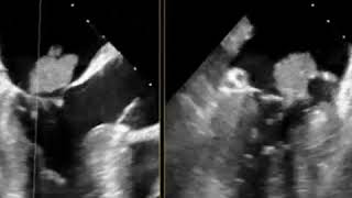 Infective Endocarditis  Vegetation  The Echo Clip [upl. by Wendolyn]