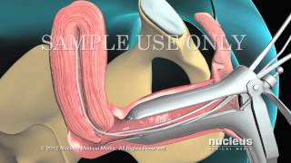 Biopsia endometrial [upl. by Mayap]