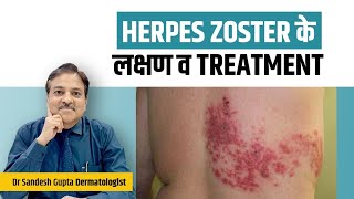 Herpes Zoster Symptoms and Treatment Dr Sandesh Gupta 99908 04085 [upl. by Annaeed]