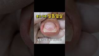 다른곳에서 관리받아 봤지만 마지막은 레푸스에서 발톱해결footcareshorts발톱관리 발톱교정ingrowingnail레푸스화정점 [upl. by Ataner380]