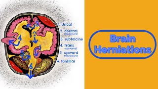 Brain Herniations and Raised ICP [upl. by Kassab]