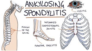 Ankylosing Spondylitis Visual Explanation for Students [upl. by Naima]