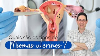 Quais são os tipos de miomas uterinos [upl. by Jemine843]