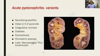 Pyelonephritis  Renal Pathology  RATS in Pathology [upl. by Orsino]