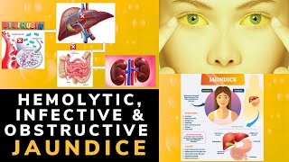 TYPES OF JAUNDICE IN ADULTS  HEMOLYTIC INFECTIVE OBSTRUCTIVE JAUNDICE  Medical Lecture [upl. by Lyssa]