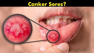 Why Do We Get Canker Sores  Symptoms Causes and treatment UrduHindi [upl. by Nodroj]