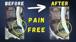 Lumbar Disc Extrusion L5 S1 recovery without surgery within 4 Months [upl. by Niro93]