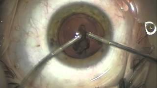 Cataract Surgery  Refractive Lens Exchange [upl. by Firmin96]