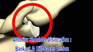 Shoulder Dislocation Hillsachs Lesion And Bankart Lesion 어깨 탈구  Bankart amp HillSachs 병변 [upl. by Dorothea]